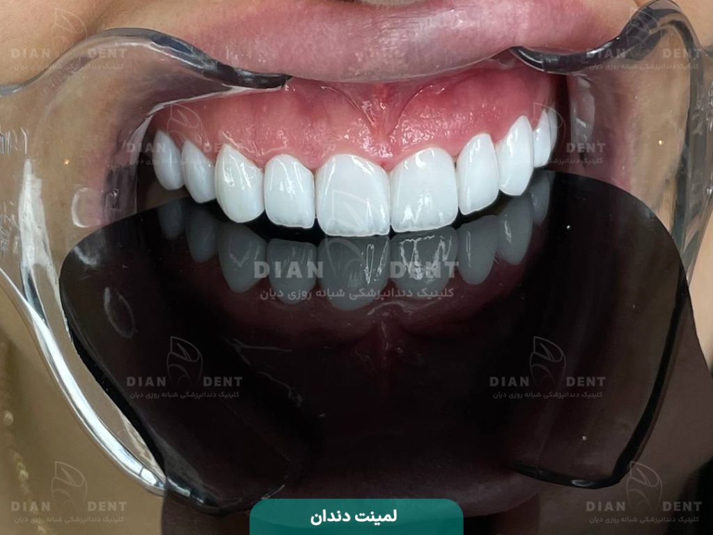 نمونه کار لمینت7