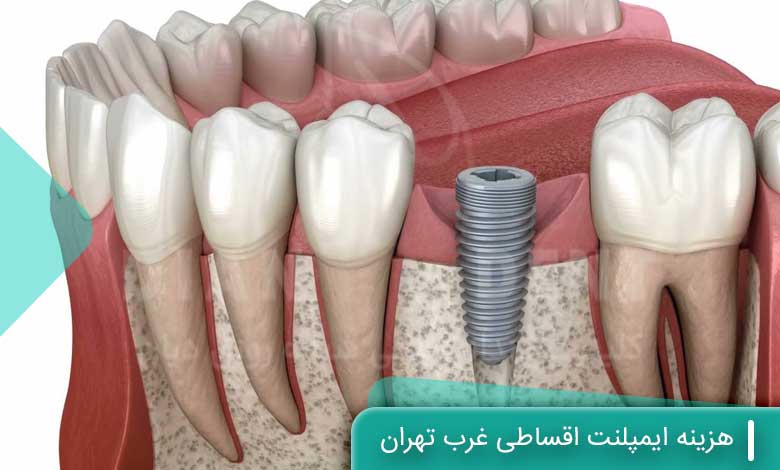 عوامل مؤثر بر هزینه ایمپلنت اقساطی غرب تهران