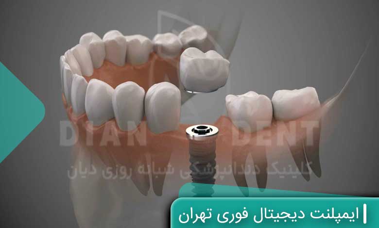 ایمپلنت دیجیتال فوری تهران