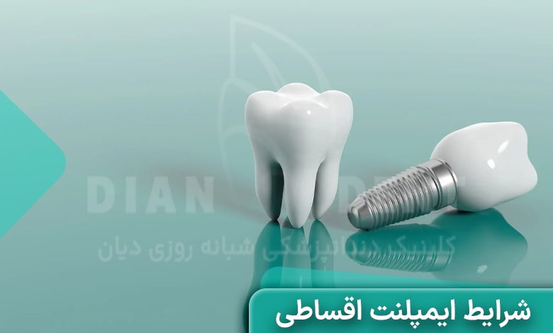 شرایط ایمپلنت اقساطی غرب تهران