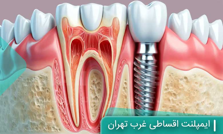 ایمپلنت اقساطی غرب تهران