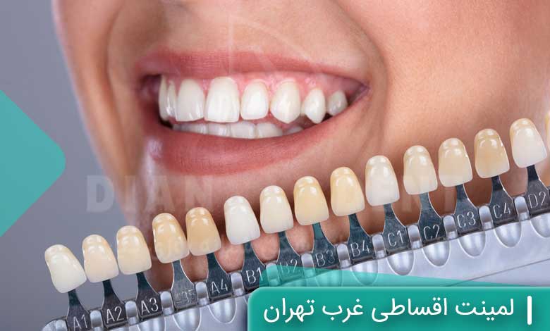 لمینت اقساطی غرب تهران