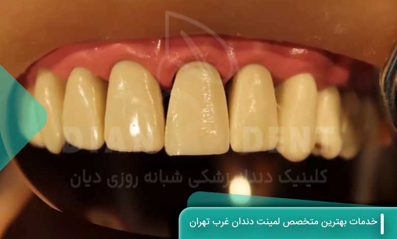 خدمات بهترین متخصص لمینت دندان غرب تهران
