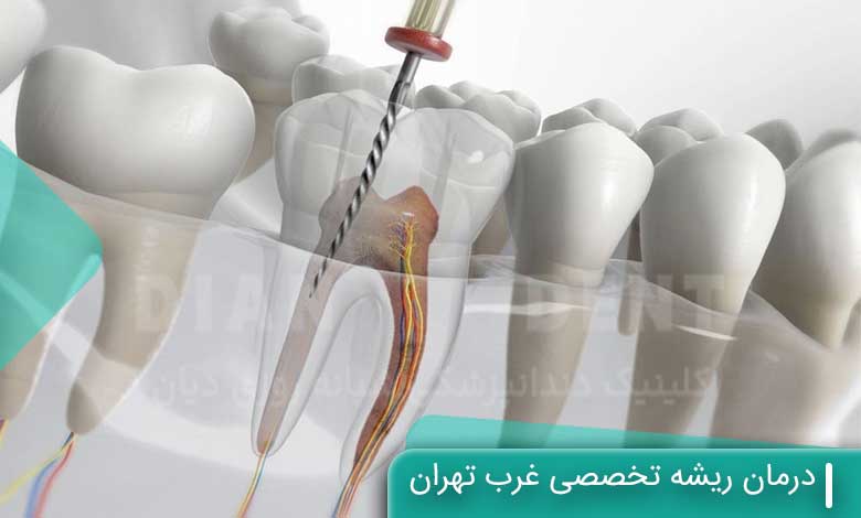 درمان ریشه تخصصی غرب تهران