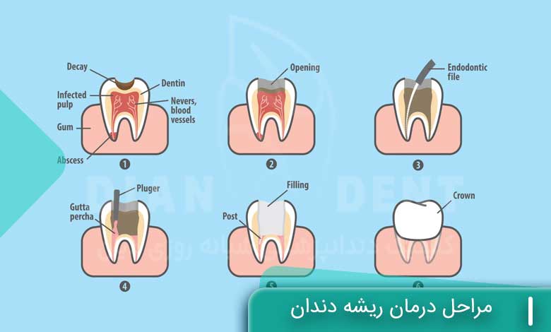مراحل درمان ریشه دندان