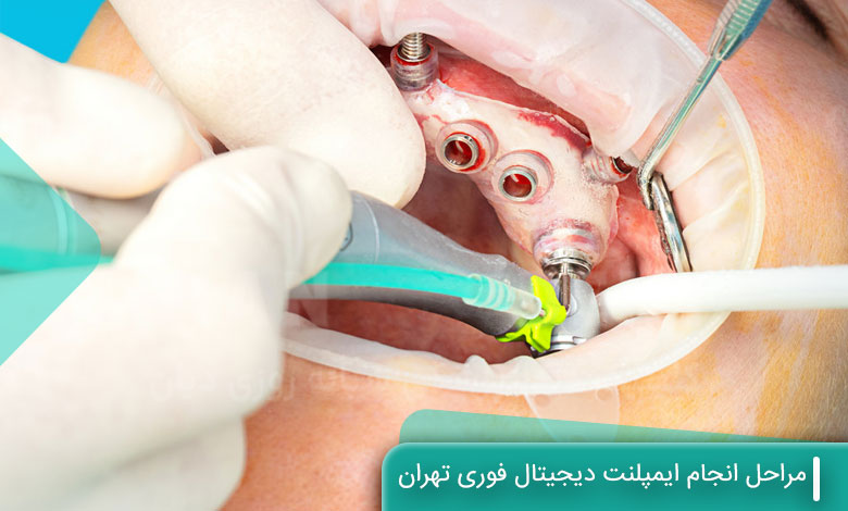 مراحل انجام ایمپلنت دیجیتال فوری تهران