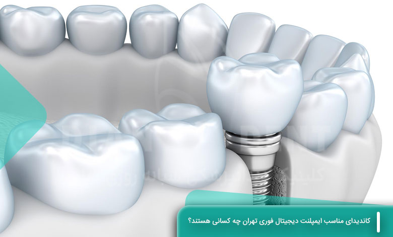 کاندیدای مناسب ایمپلنت دیجیتال فوری تهران