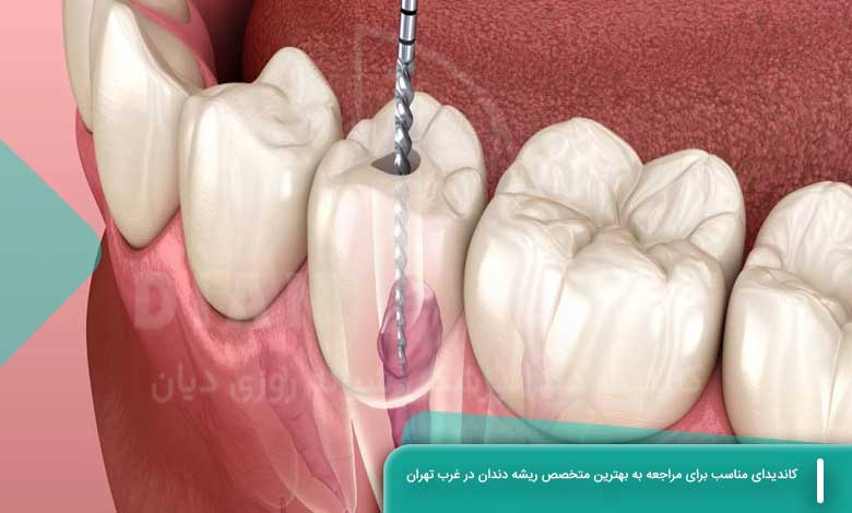 کاندیدای مناسب برای مراجعه به بهترین متخصص ریشه دندان در غرب تهران