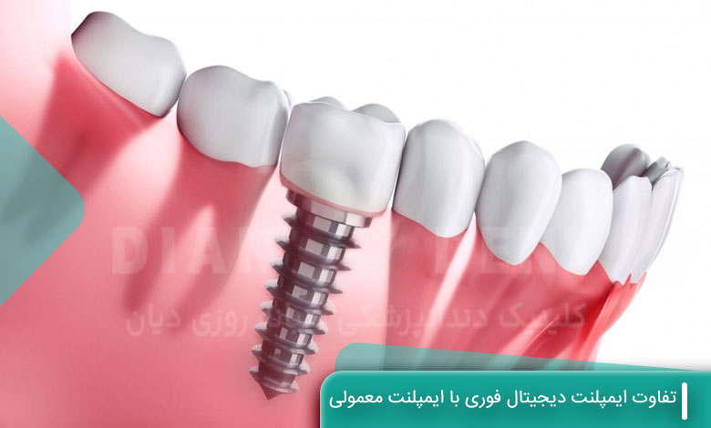 تفاوت ایمپلنت دیجیتال فوری با ایمپلنت معمولی