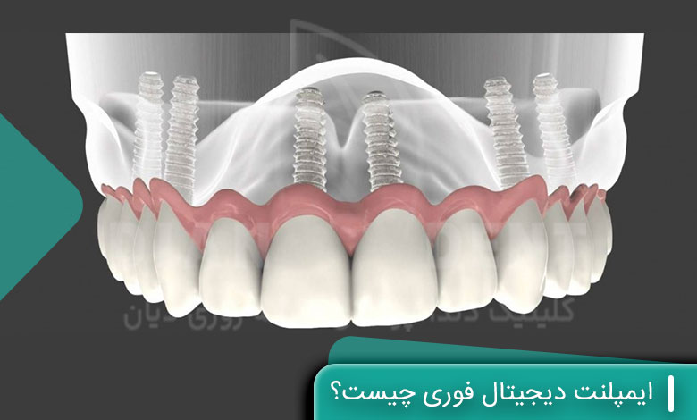 ایمپلنت دیجیتال فوری چیست؟