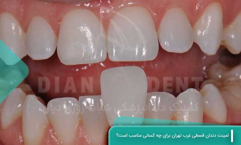 لمینت دندان قسطی غرب تهران برای چه کسانی مناسب است
