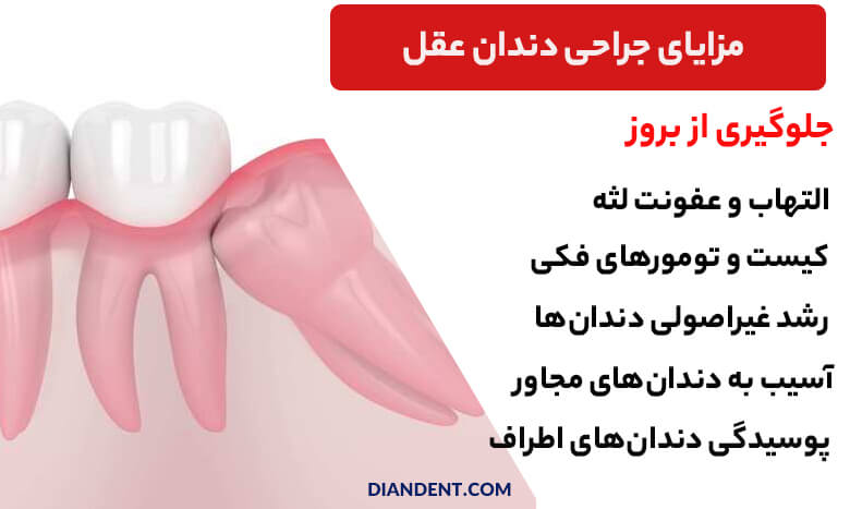 مزایای جراحی دندان عقل چیست