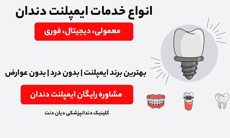 کاشت دندان در بهترین مرکز ایمپلنت غرب تهران - دیان دنت