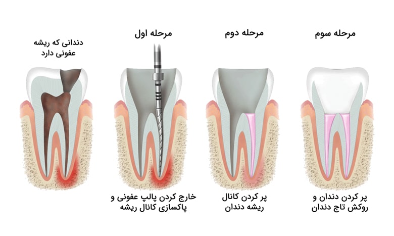 مراحل درمان ریشه تخصصی غرب تهران