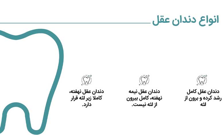 انواع روش های جراحی دندان عقل