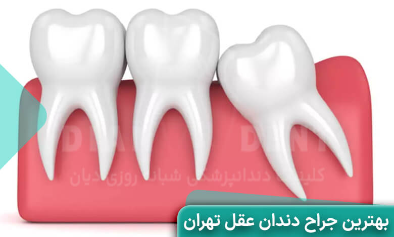 بهترین جراح دندان عقل تهران