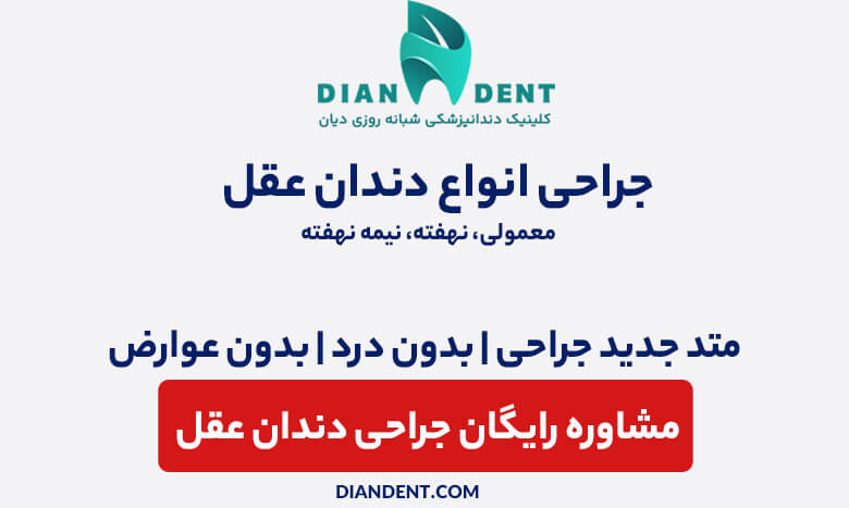 مشاوره رایگان جراحی دندان عقل در دیان دنت