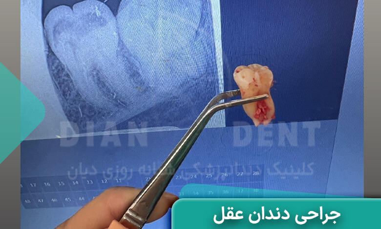 نمونه کار جراحی دندان عق نهفته در دیان دنت