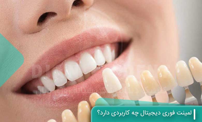 کاربرد لمینت دیجیتال فوری