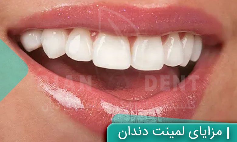 مزایای لمینت دندان