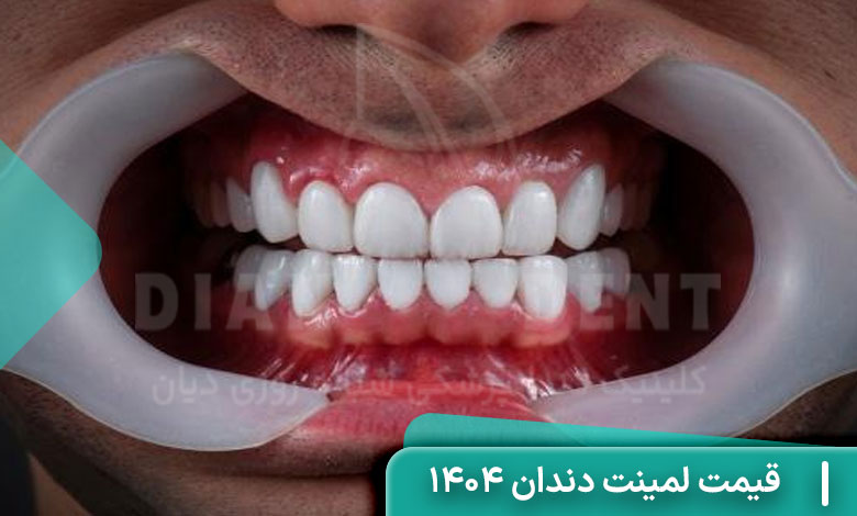 قیمت لمینت دندان 1404