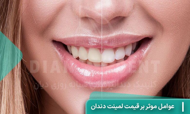 عوامل موثر بر قیمت لمینت دندان