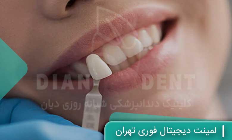 لمینت دیجیتال فوری تهران