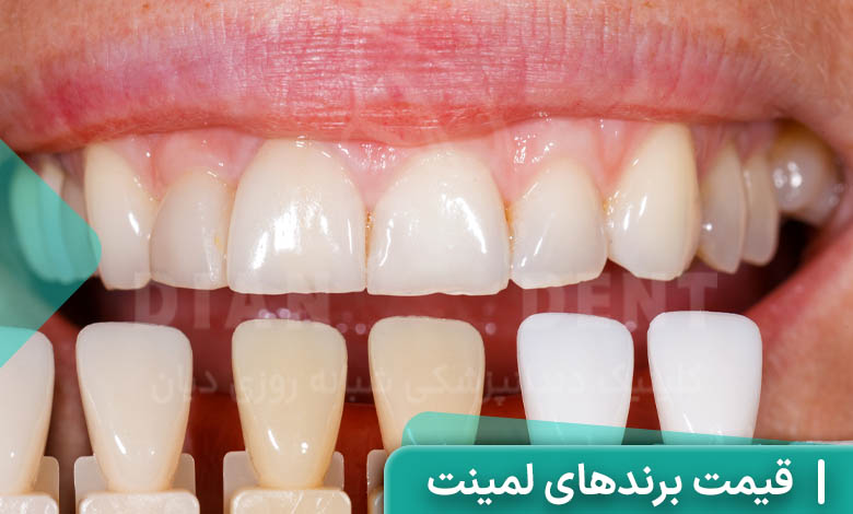 قیمت برندهای مختلف لمینت دندان