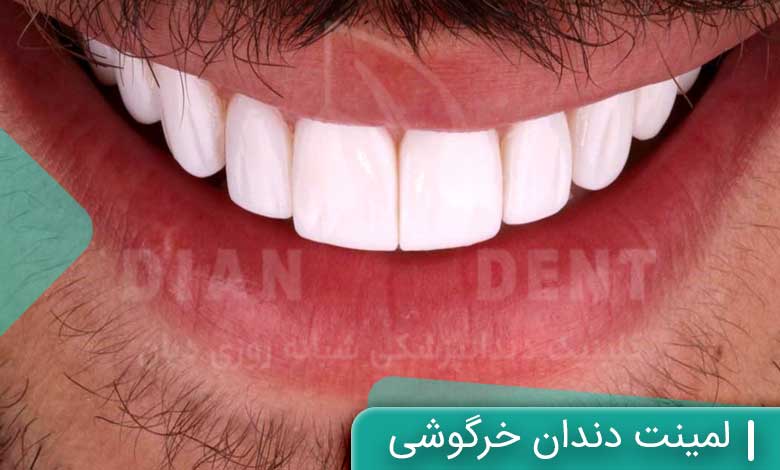 لمینت دندان چیست