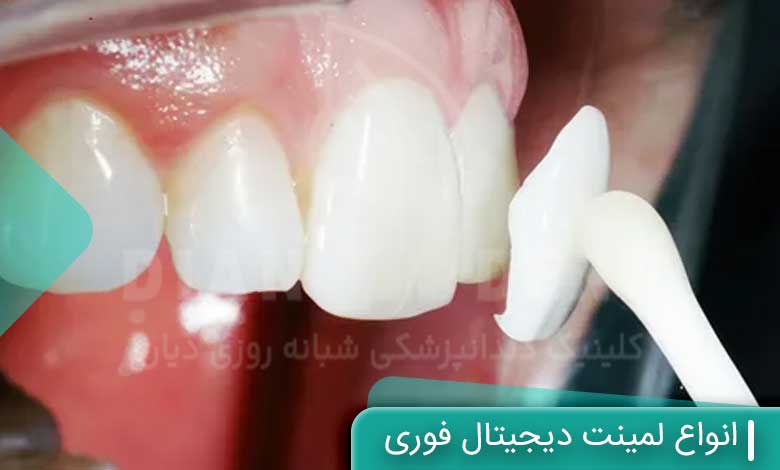 انواع لمینت دیجیتال فوری