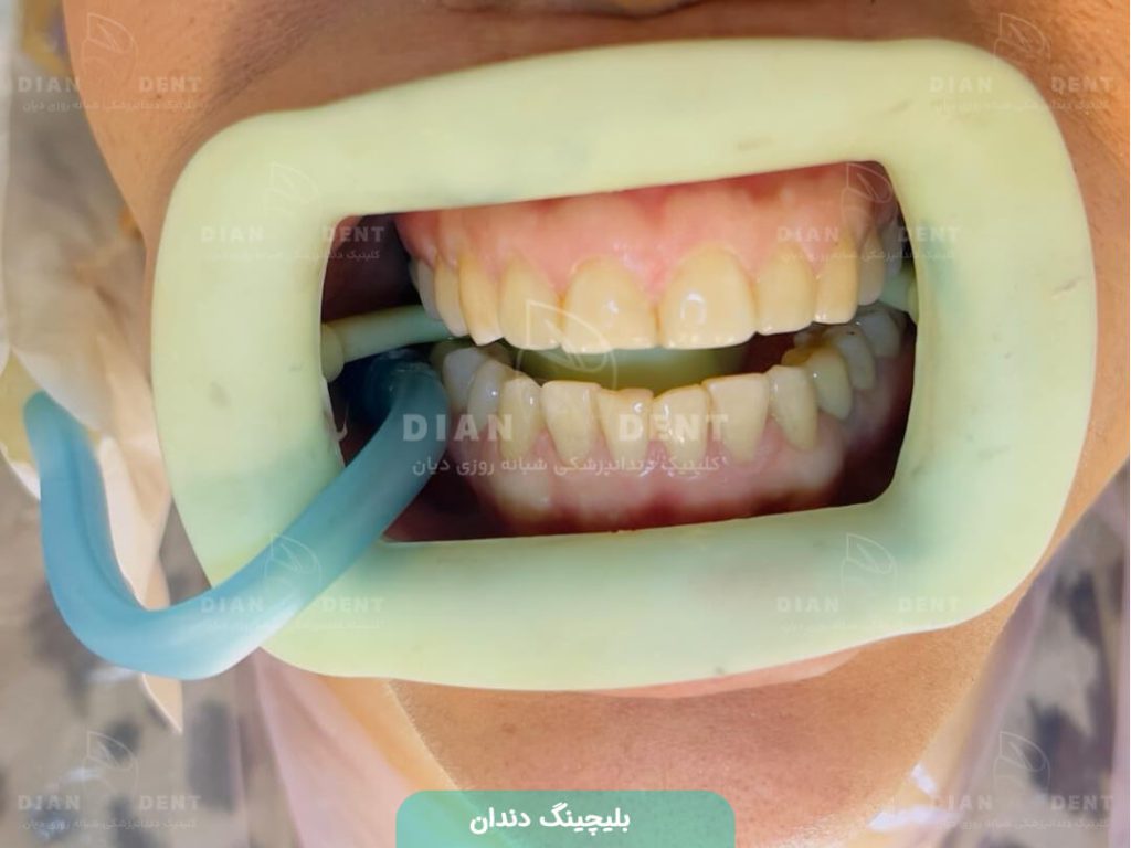 عکس بلیچینگ نمونه کار دیان دنت