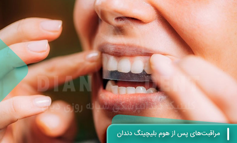 مراقبت‌های پس از هوم بلیچینگ دندان