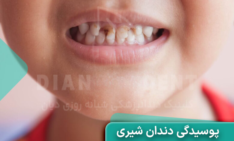 پوسیدگی دندان شیری کودکان