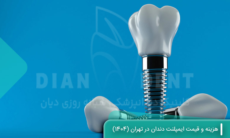 هزینه و قیمت ایمپلنت دندان در تهران (1404)
