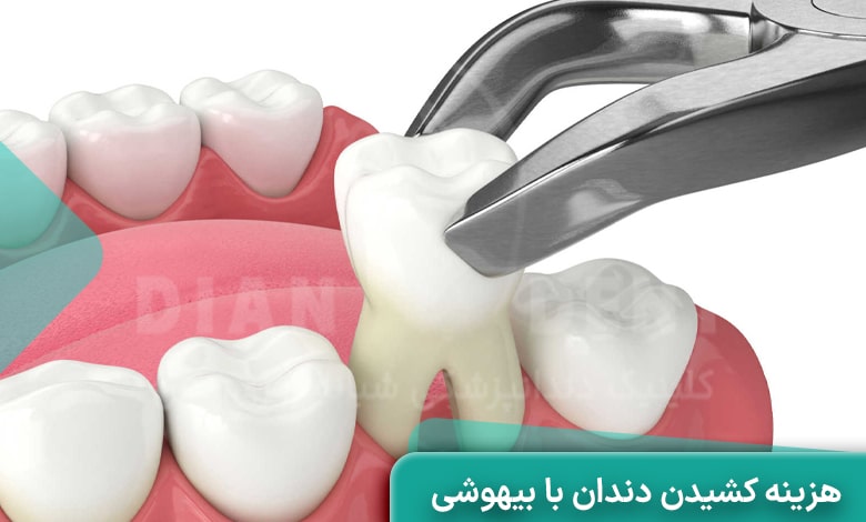 هزینه کشیدن دندان با بیهوشی چقدر است؟