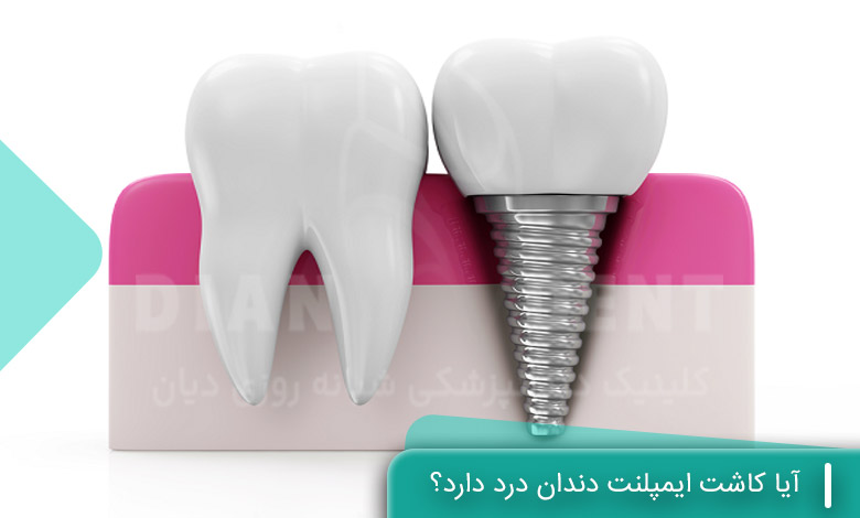 آیا کاشت ایمپلنت دندان درد دارد؟