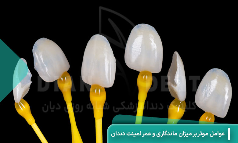 عوامل موثر بر میزان ماندگاری و عمر لمینت دندان