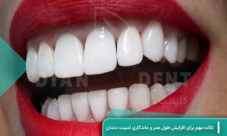 نکات مهم برای افزایش طول عمر و ماندگاری لمینت دندان