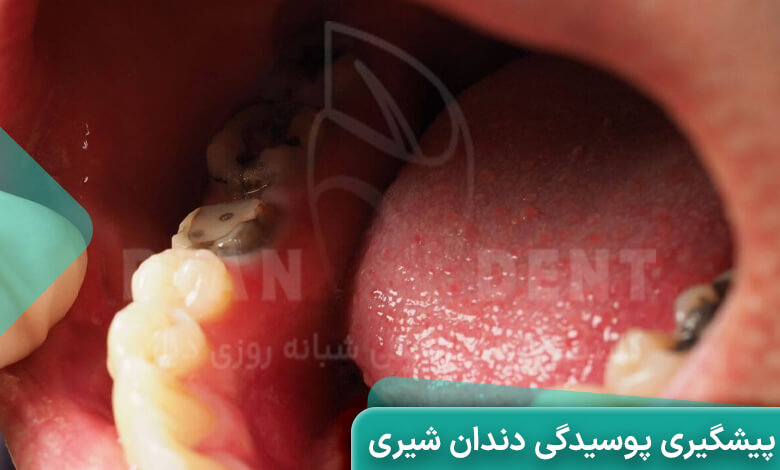 پیشگیری از پوسیدگی دندان شیری کودکان