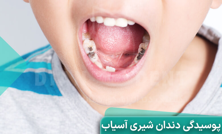 علائم پوسیدگی دندان آسیاب شیری