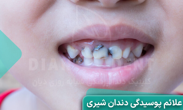 علائم پوسیدگی دندان شیری کودکان