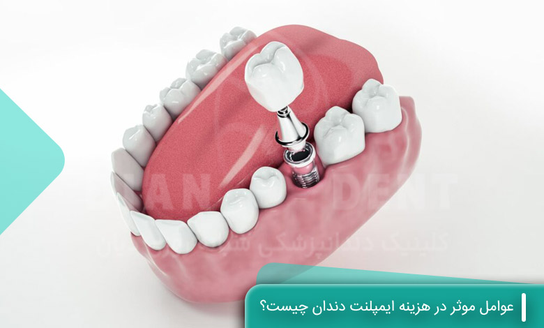 عوامل موثر در هزینه ایمپلنت دندان چیست؟