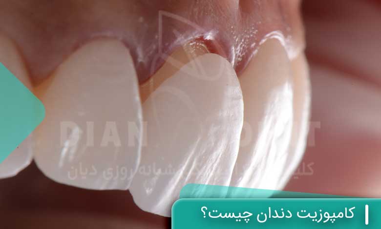 کامپوزیت دندان چیست؟