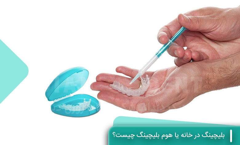 بلیچینگ در خانه یا هوم بلیچینگ چیست؟