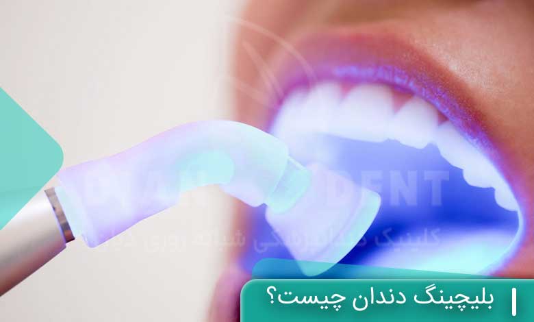 بلیچینگ دندان چیست؟