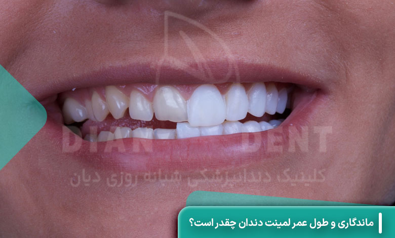 ماندگاری و طول عمر لمینت دندان چقدر است؟
