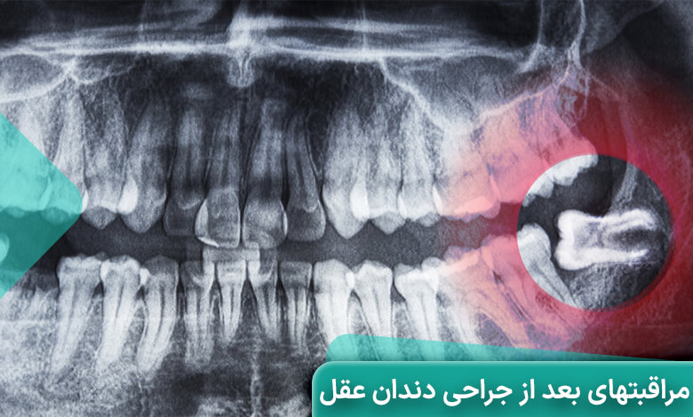 بعد از کشیدن دندان عقل چی بخوریم؟