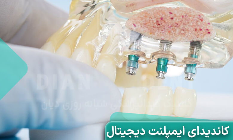 ایمپلنت دیجیتال برای چه کسانی مناسب است؟