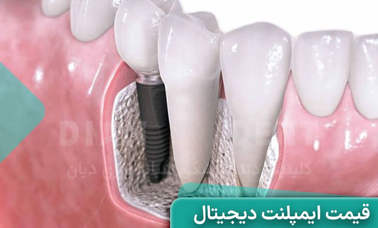قیمت ایمپلنت دیجیتال