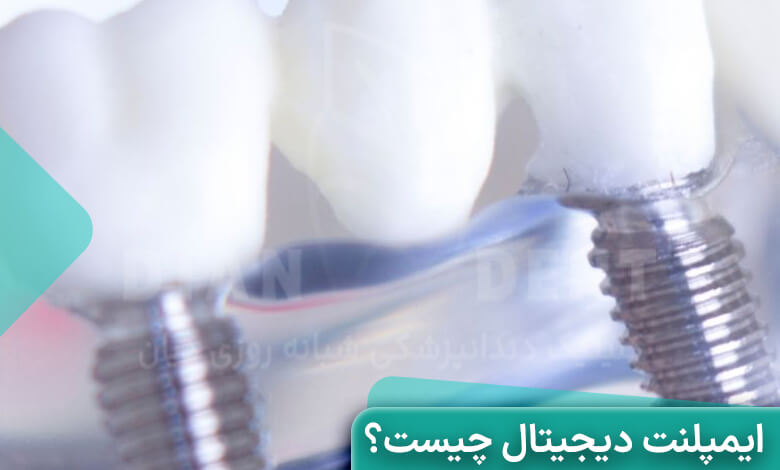 ایمپلنت دیجیتال چیست